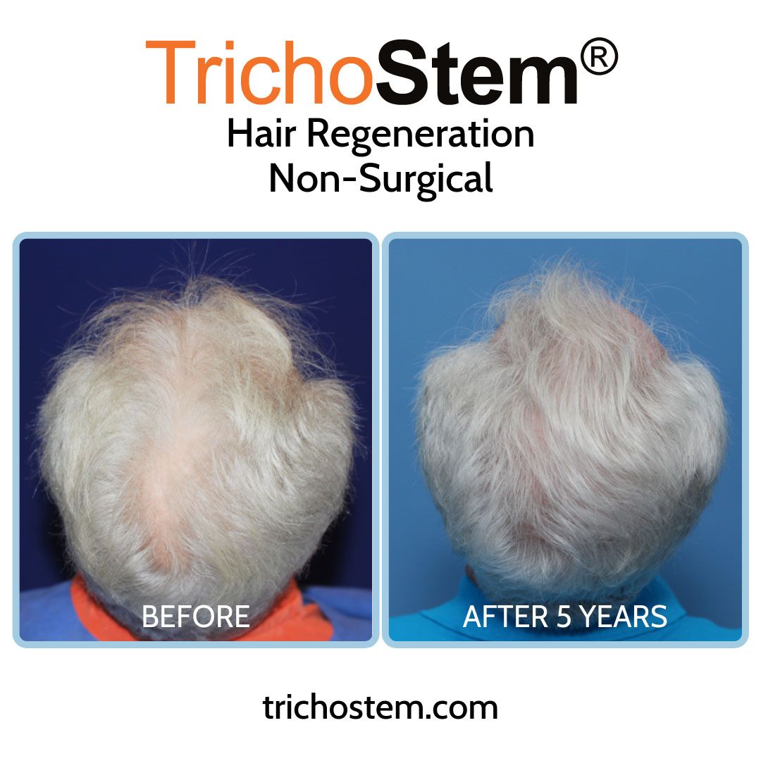 TrichoStem® Hair Regeneration results in a male patient with moderate hair thinning 5 years after a single injection and no finasteride.