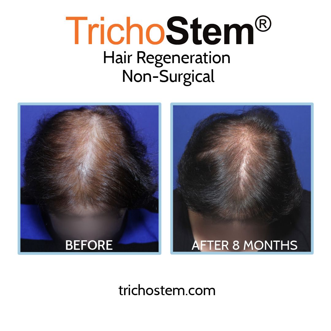 hair regeneration customized treatment for female hair loss, before and after 8 months