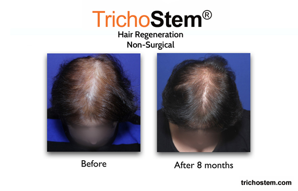 Hair regeneration customized treatment for women, before and after 8 months