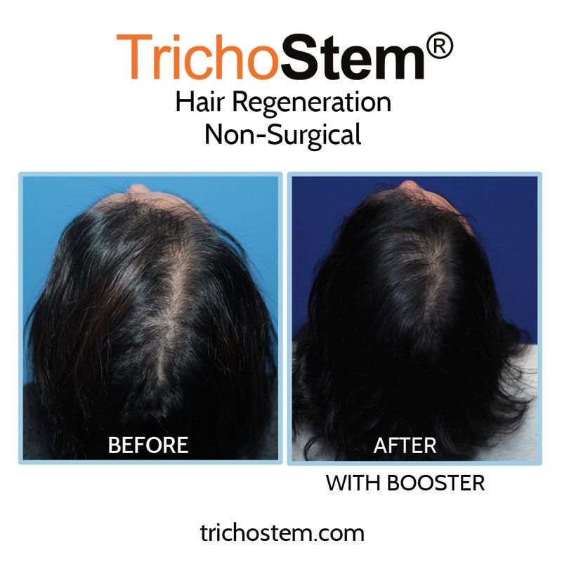 before and after hair regeneration with booster. A second TrichoStem™ Hair Regeneration injection can be administered 15-24 months after the initial treatment to thicken fine hair growth from the first treatment, at no extra charge
