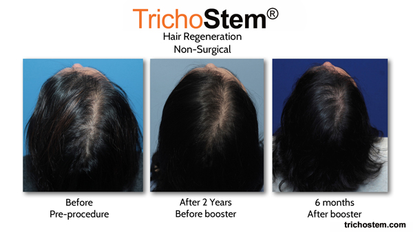before, 2 yrs after and 6 months after booster results of hair regeneration on female pattern hair loss. A booster injection can be administered 15-24 months after the initial treatment to thicken fine hair growth from the first treatment, at no extra charge