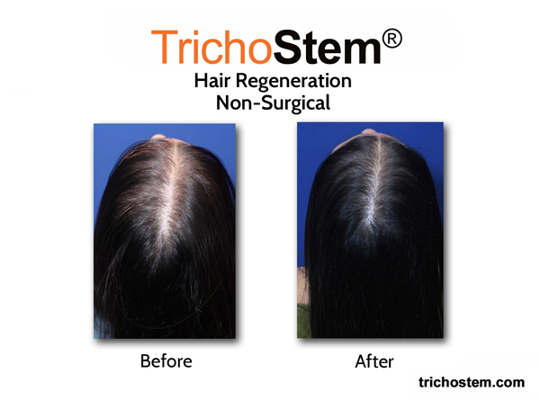 Before and after hair regeneration on female hair loss. After improving diagnosis of female pattern hair loss, TrichoStem Hair Regeneration attained a 99% success rate of treatment