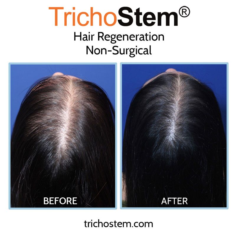 before and after hair regeneration on female hair loss. After improving diagnosis of female pattern hair loss, TrichoStem Hair Regeneration attained a 99% success rate of treatment