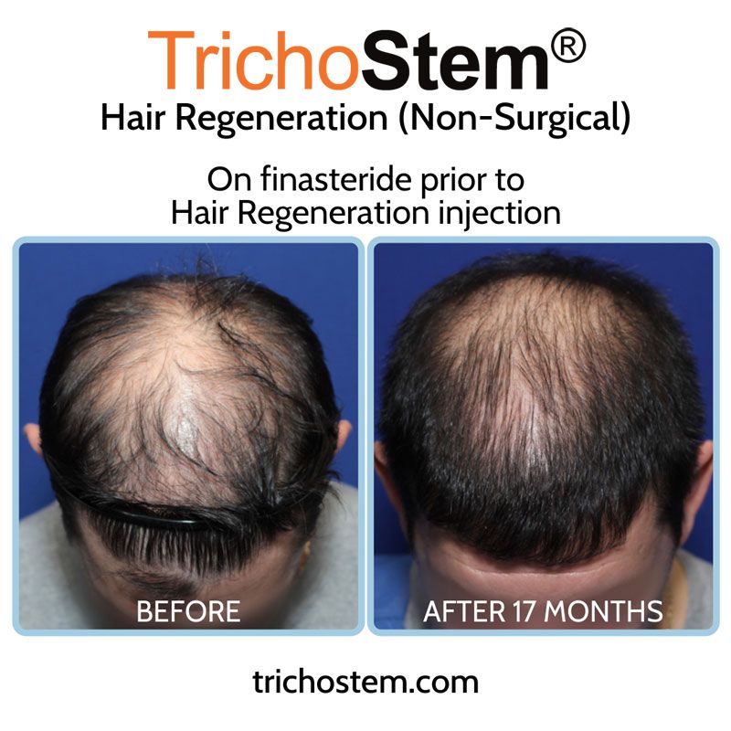 before and 17 months after TrichoStem™ Hair Regeneration on male patient taking finasteride
