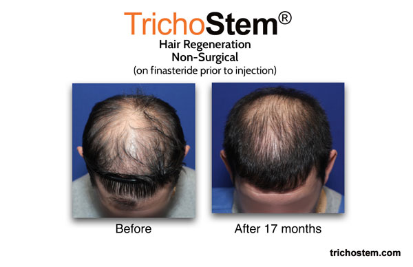 before and 17 months after TrichoStem™ Hair Regeneration on male patient taking finasteride
