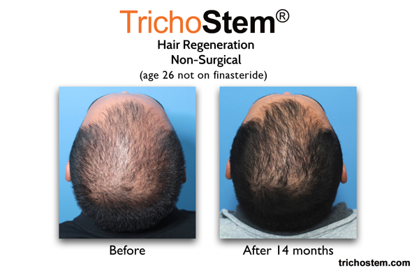 before and 14 months after TrichoStem Hair Regeneration on male patient in mid 20s