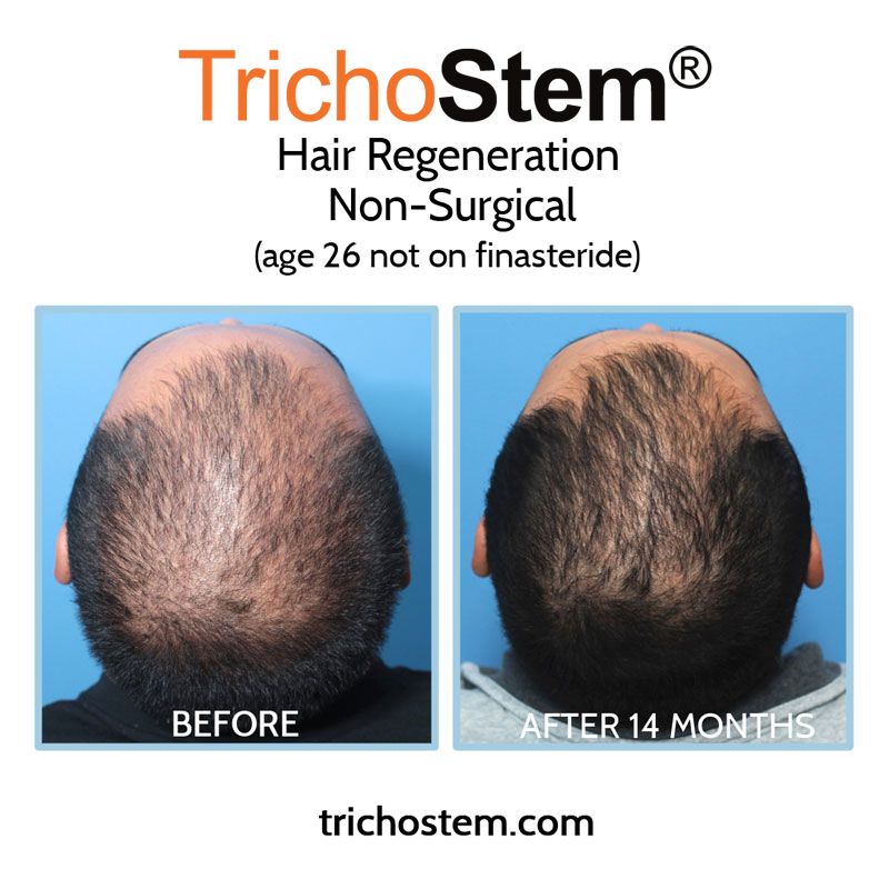 before and 14 months after TrichoStem Hair Regeneration on male patient aged mid 20s