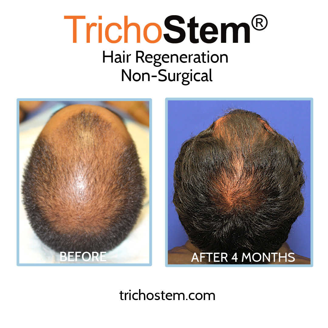 before and 4 months after hair regeneration with Regular follow-up sessions to monitor patients improvement in scalp coverage