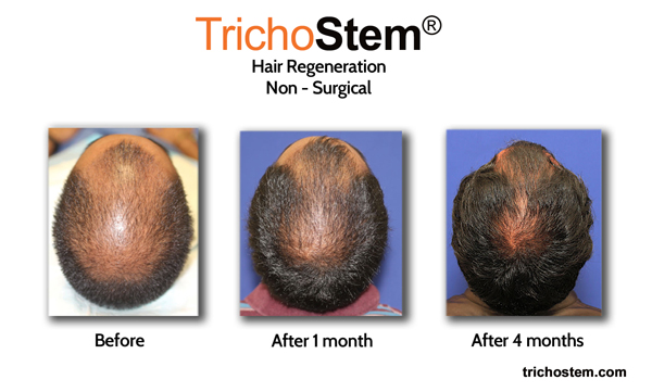 before, after 1 month and after 4 months of hair regeneration treatment -Regular follow-up sessions are important to show patients improvement in scalp coverage.