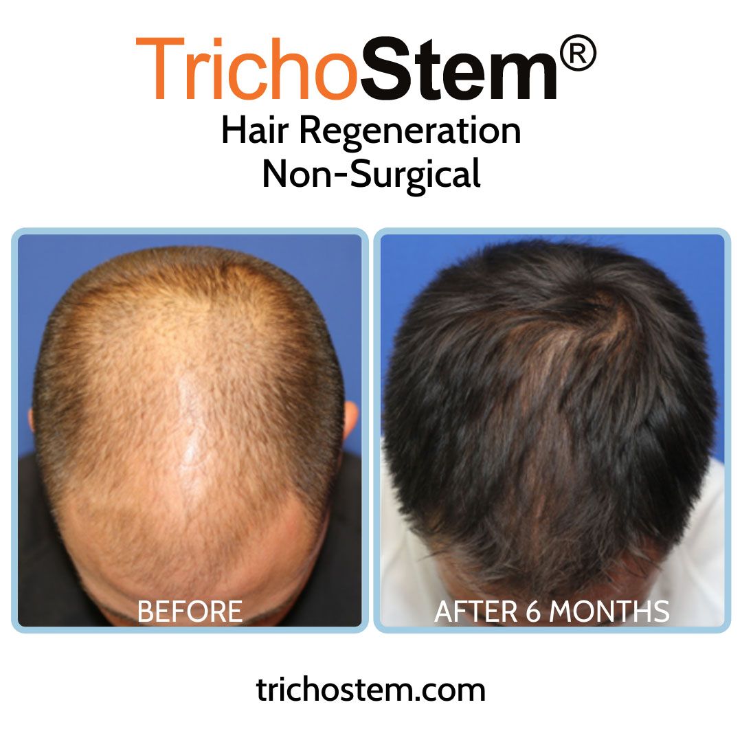 This photo is one of our TrichoStem® Hair Regeneration patients have been stolen by several medical practices, and even used in a televised feature by another practice.